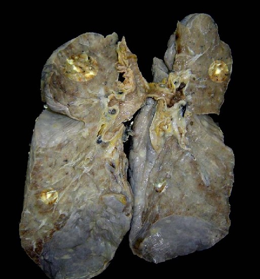 Detalle nódulos pulmonares - <div style=